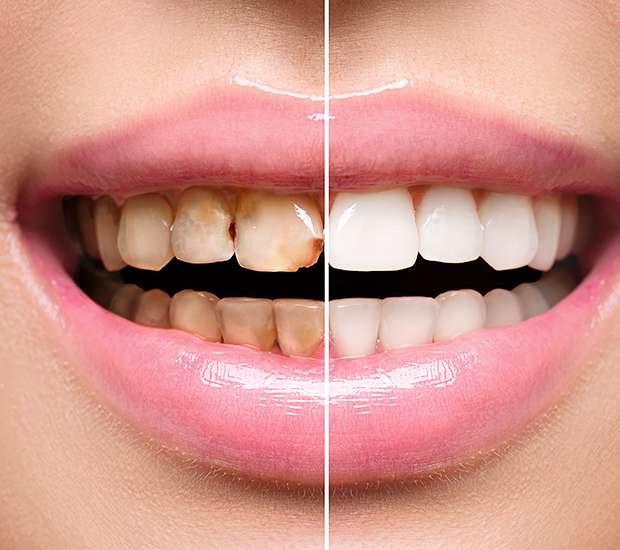 Pleasant Grove Dental Implant Restoration